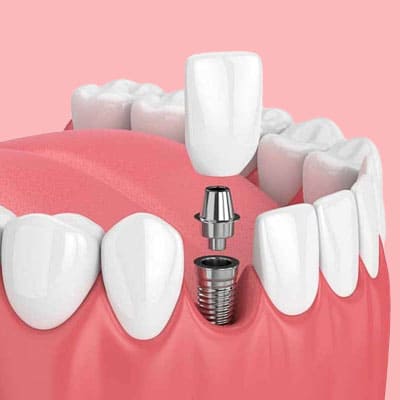 dental implants in dharmapuri