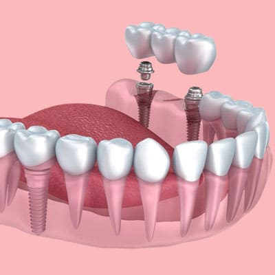 prosthodiontic dentistry in dharmapuri