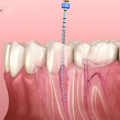 root-canal-treatment dentistry in dharmapuri