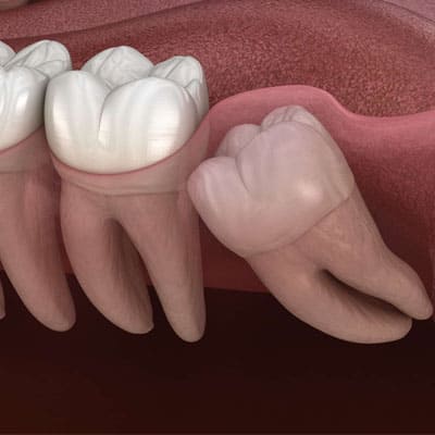 wisdom tooth removal in dharmapuri